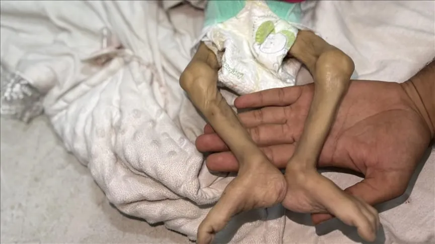 Gazze’de Açlık Can Almaya Devam Ediyor: 7 Aylık Bebek Hayatını Kaybetti